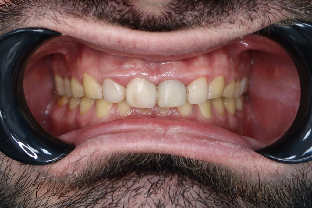 пациент до имплантации