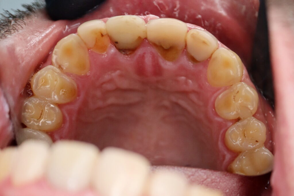 пациент до имплантации