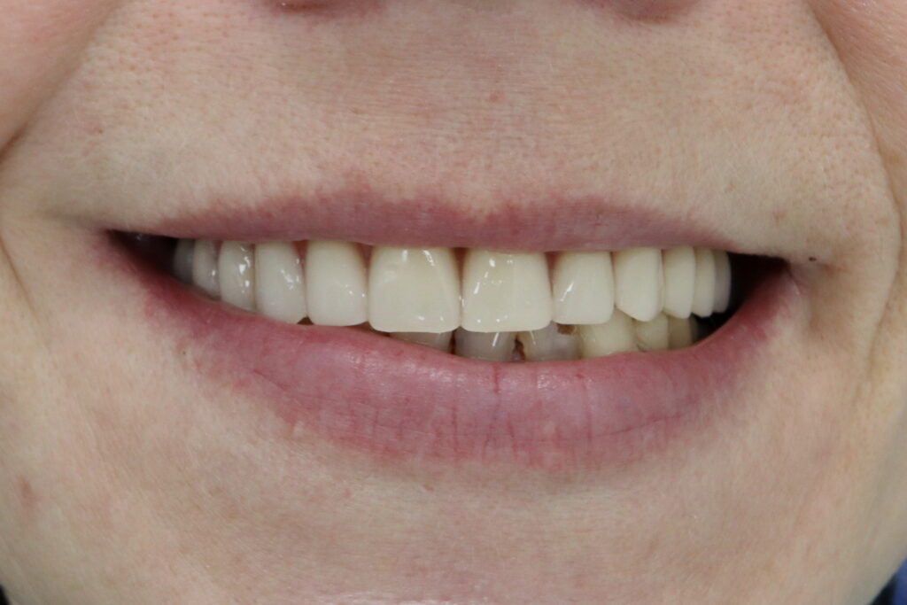 Имплантация All-on-6 Megagen AnyRidge