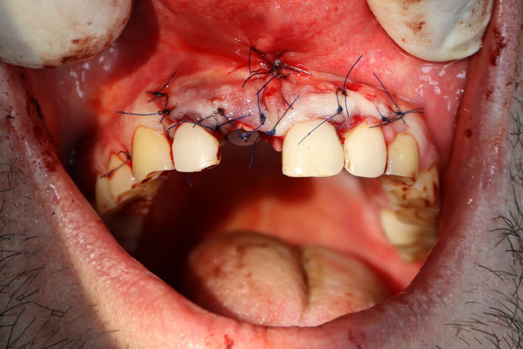 результат имплантации