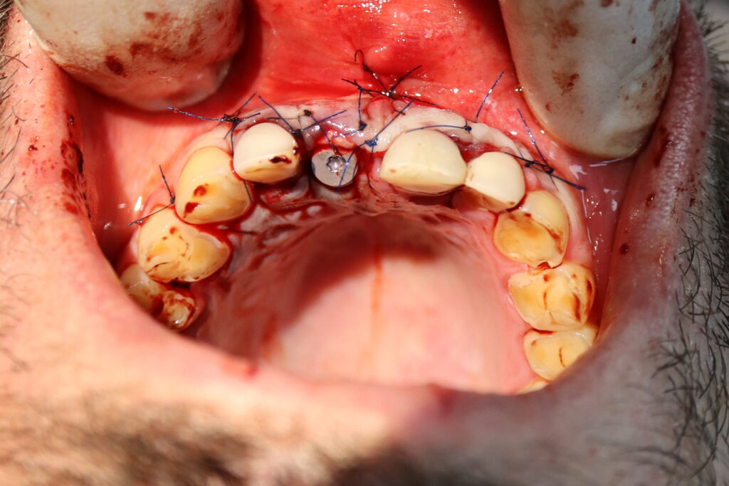 результат имплантации