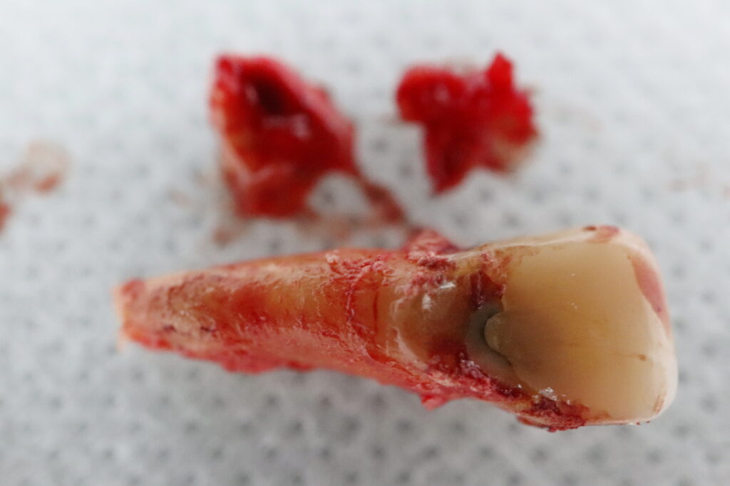 удаление зуба