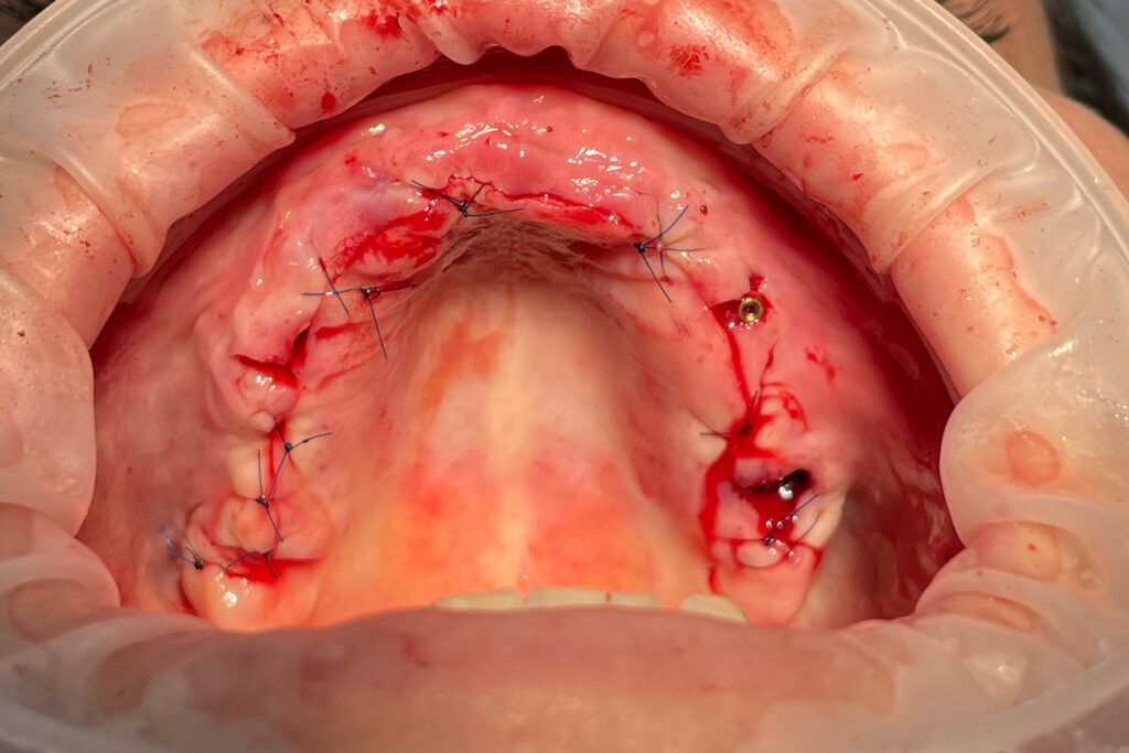 Процесс имплантации