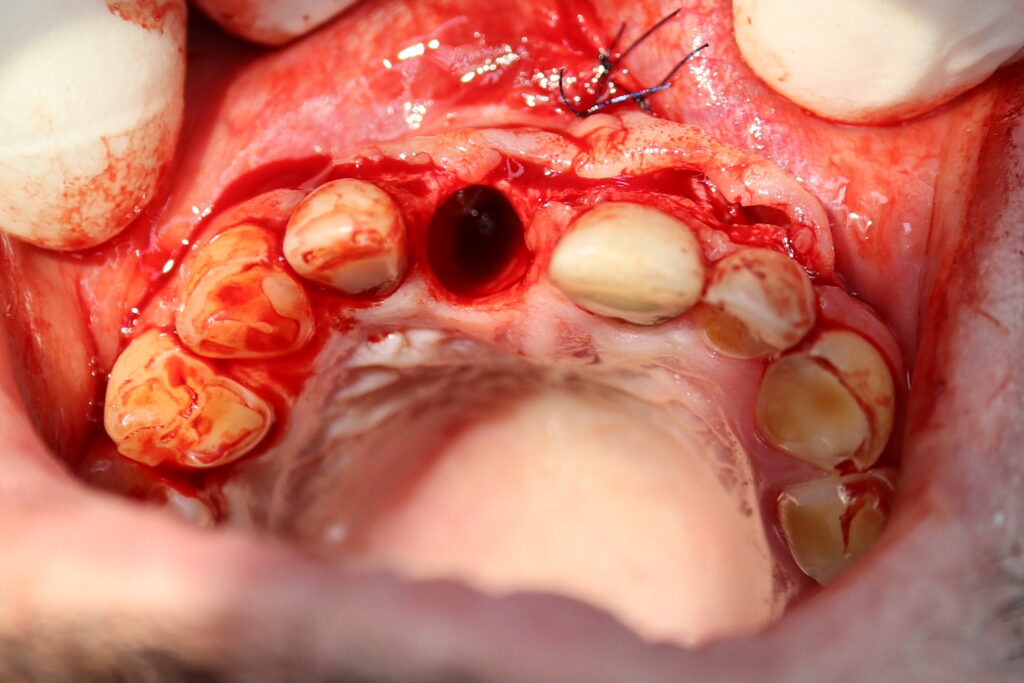 удаление зуба