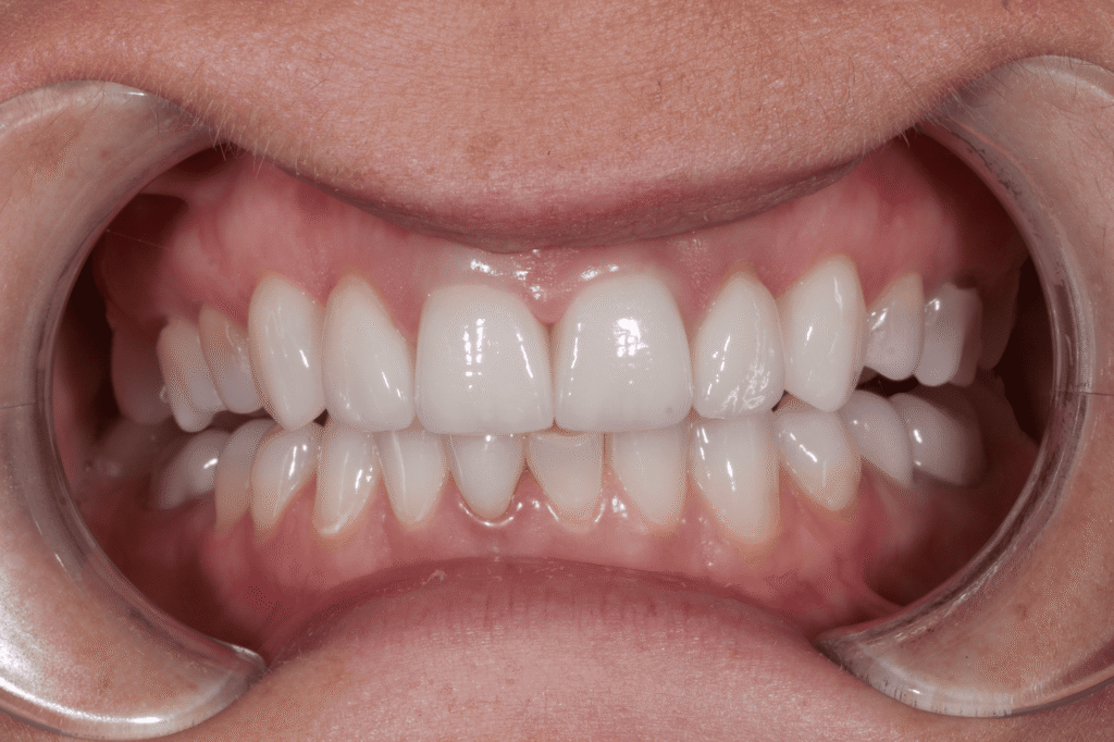 результат протезирования