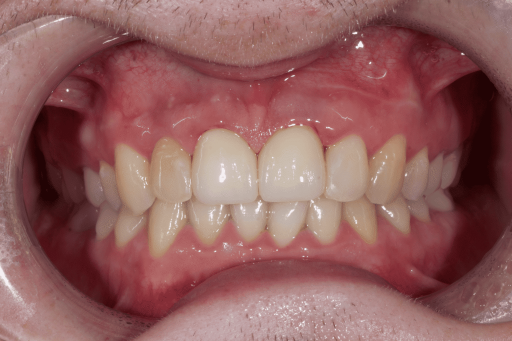 результат протезирования