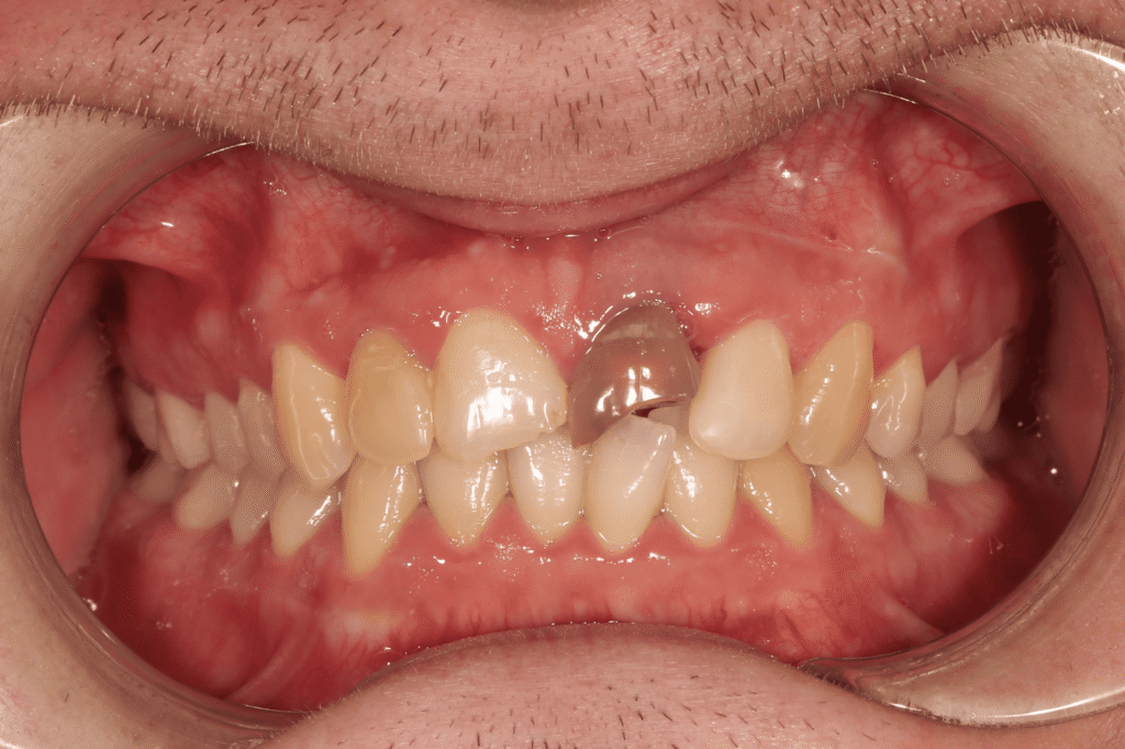 пациент до протезирования