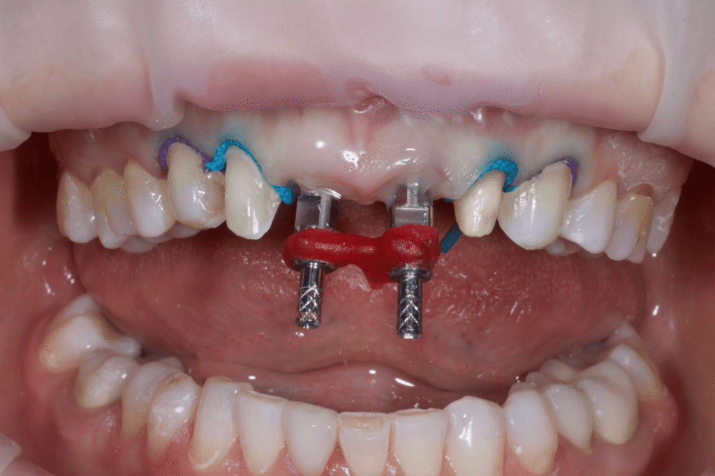 процесс имплантации