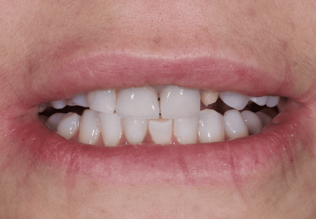 пациент до протезирования