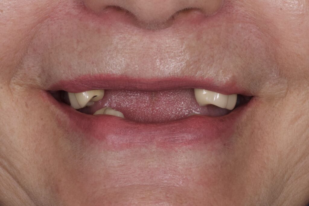 пациент до протезирования