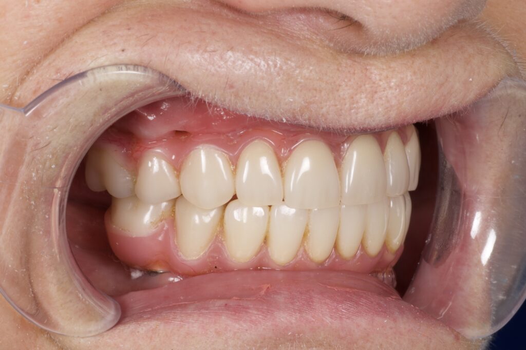 пациент после протезирования