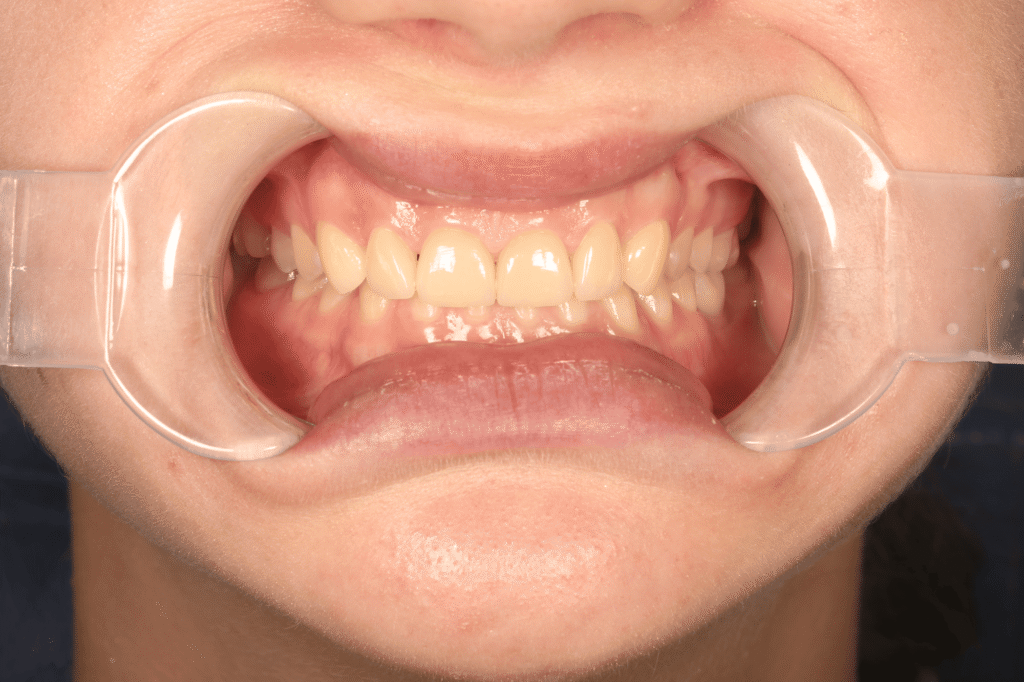 результат протезирования