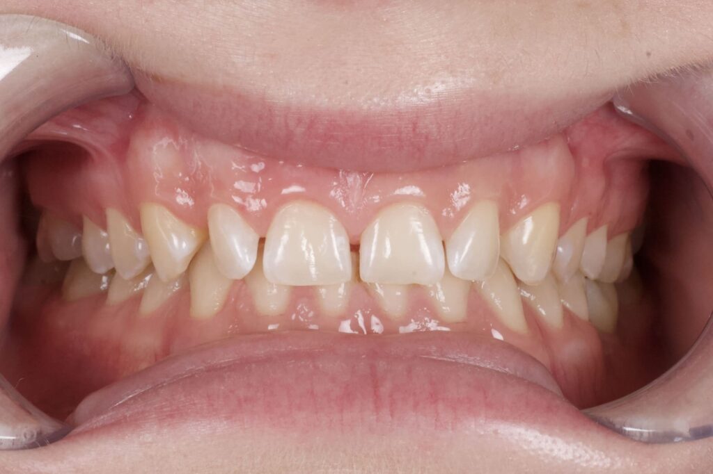 пациент до протезирования