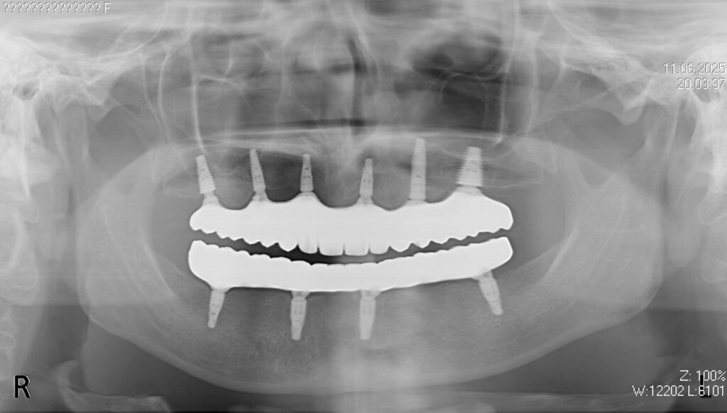 результат протезирования