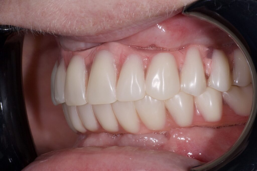 результат протезирования