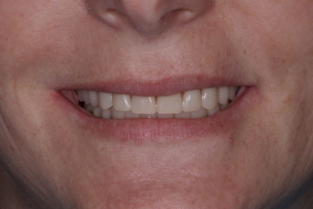 Установка постоянных циркониевых протезов после имплантации All-on-6