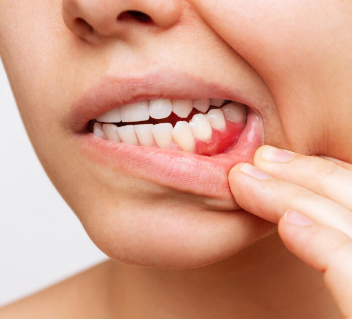 Лечение гингивита в Бишкеке