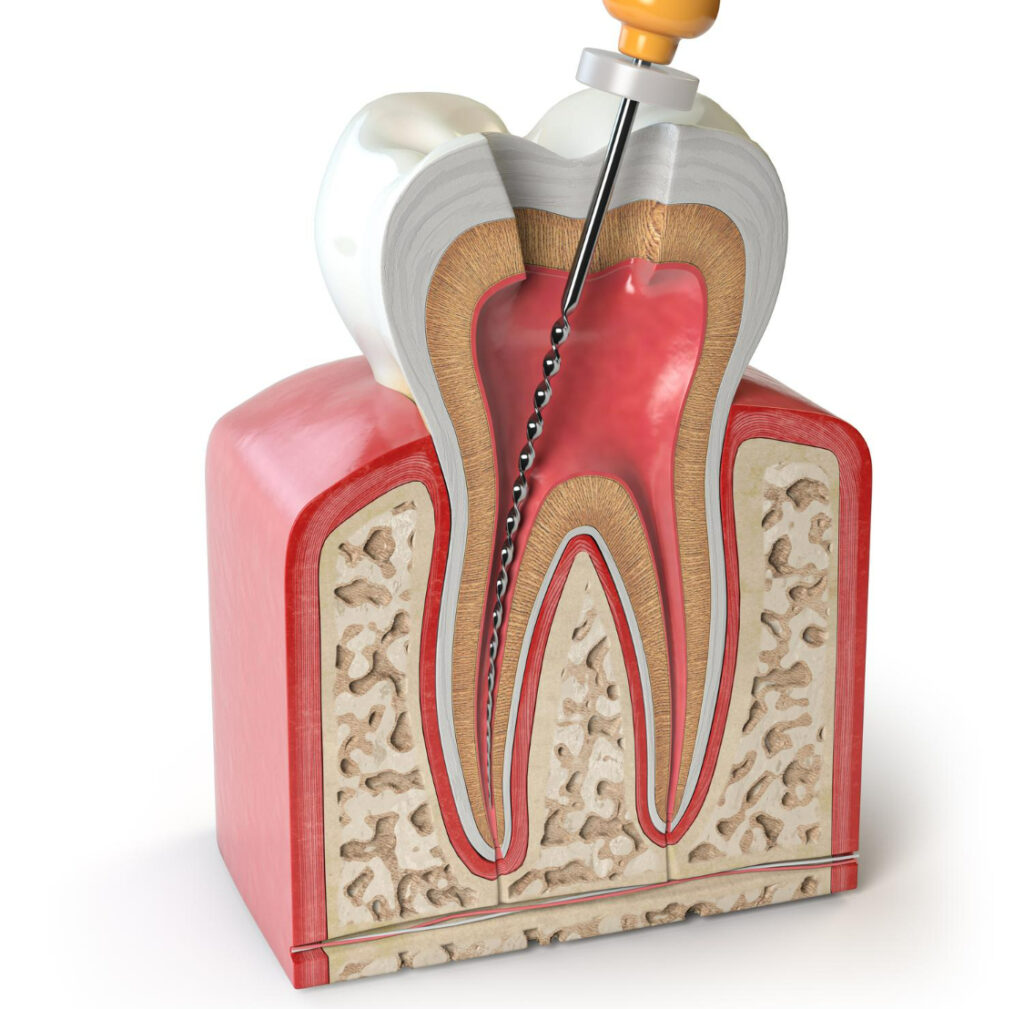 Перелечивание корневых каналов в Бишкеке