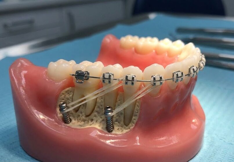 Установка ортодонтических миниимплантов в Бишкеке